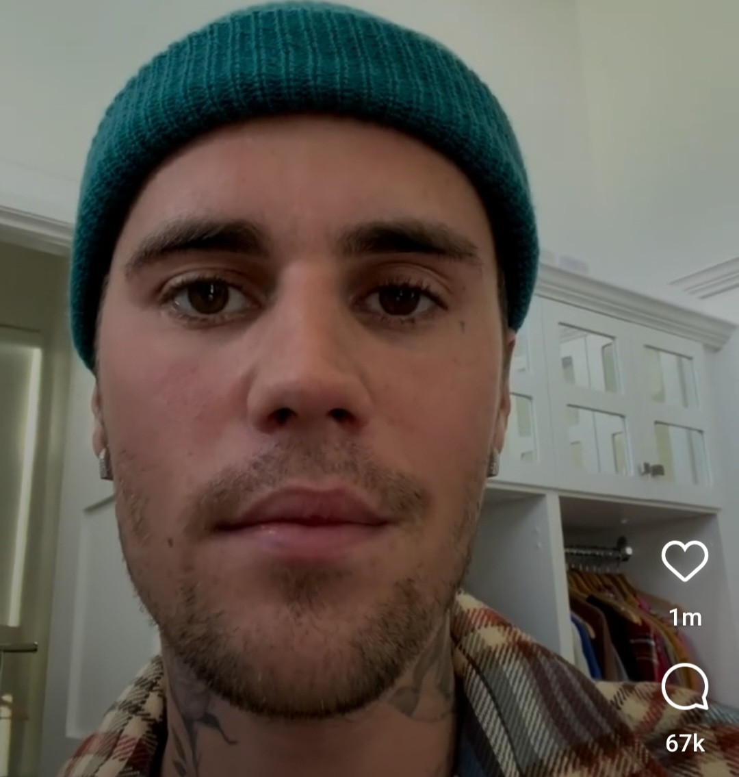 Justin Bieber Reveals He’s Been Diagnosed with Ramsay Hunt Syndrome Causing Half of His Face to be Paralysed (video)